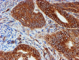 SCFD1 / SLY1 Antibody - IHC of paraffin-embedded Adenocarcinoma of Human endometrium tissue using anti-SCFD1 mouse monoclonal antibody.