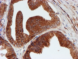 SCFD1 / SLY1 Antibody - IHC of paraffin-embedded Carcinoma of Human prostate tissue using anti-SCFD1 mouse monoclonal antibody.