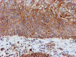 SCFD1 / SLY1 Antibody - IHC of paraffin-embedded Carcinoma of Human bladder tissue using anti-SCFD1 mouse monoclonal antibody.