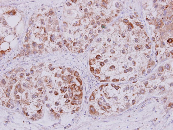 SCG10 / STMN2 Antibody - STMN2 antibody detects STMN2 protein at cytoplasm on Liver carcinoma by immunohistochemical analysis. Sample: Paraffin-embedded Liver carcinoma. STMN2 antibody dilution:1:250.