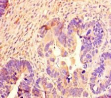 SCG2 / Secretogranin II Antibody - Immunohistochemistry of paraffin-embedded human ovarian cancer at dilution of 1:100