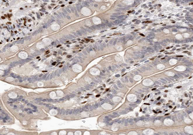 SCGB2A1 / Mammaglobin B Antibody - 1:100 staining human colon carcinoma tissue by IHC-P. The tissue was formaldehyde fixed and a heat mediated antigen retrieval step in citrate buffer was performed. The tissue was then blocked and incubated with the antibody for 1.5 hours at 22°C. An HRP conjugated goat anti-rabbit antibody was used as the secondary.