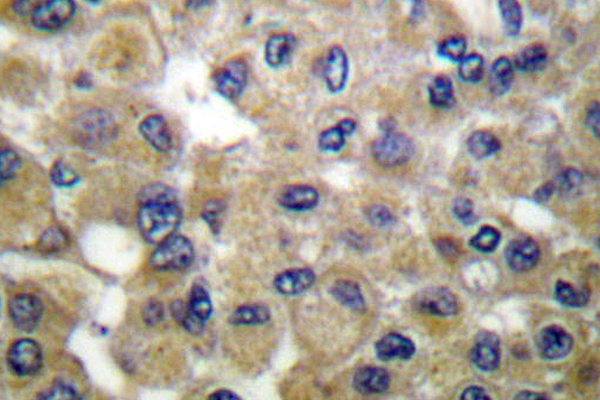 SCGB2A1 / Mammaglobin B Antibody - IHC of Mammaglobin B (K23) pAb in paraffin-embedded human breast carcinoma tissue.