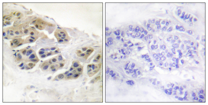 SCGB2A2 / Mammaglobin A Antibody - Immunohistochemistry analysis of paraffin-embedded human breast carcinoma tissue, using Mammaglobin Antibody. The picture on the right is blocked with the synthesized peptide.