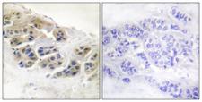 SCGB2A2 / Mammaglobin A Antibody - Immunohistochemistry analysis of paraffin-embedded human breast carcinoma tissue, using Mammaglobin Antibody. The picture on the right is blocked with the synthesized peptide.