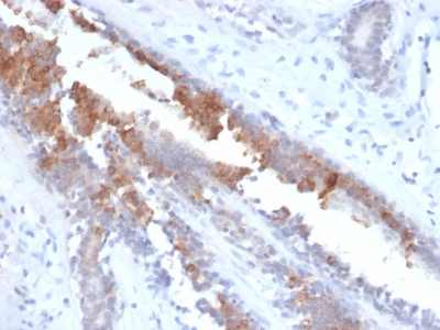 SCGB2A2 / Mammaglobin A Antibody - Formalin-fixed, paraffin-embedded human Breast Carcinoma stained with Rabbit Recombinant Monoclonal Antibody (MGB1/2123R) to Mammaglobin.