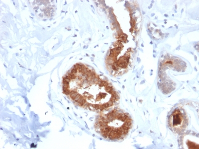 SCGB2A2 / Mammaglobin A Antibody - Formalin-fixed, paraffin-embedded human Breast Carcinoma stained with Rabbit Recombinant Monoclonal Antibody (MGB1/2123R) to Mammaglobin.