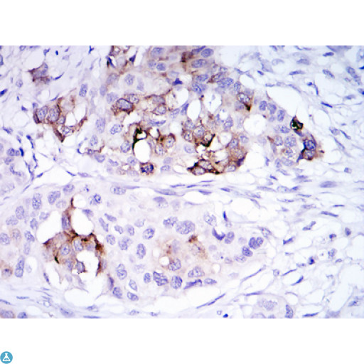 SCGB2A2 / Mammaglobin A Antibody - Immunohistochemistry (IHC) analysis of paraffin-embedded mammary cancer tissues with DAB staining using Mammaglobin A Monoclonal Antibody.