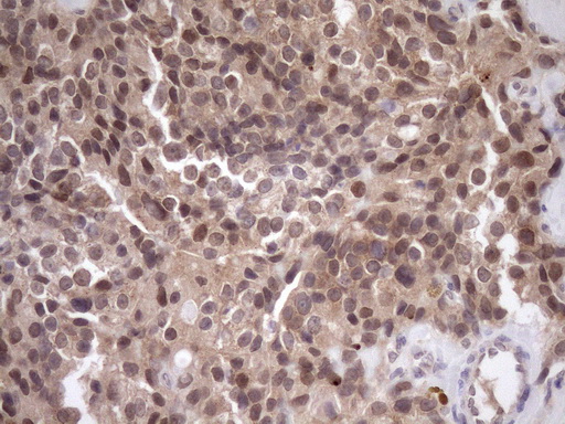 SCMH1 Antibody - Immunohistochemical staining of paraffin-embedded Adenocarcinoma of Human breast tissue using anti-SCMH1 mouse monoclonal antibody. (Heat-induced epitope retrieval by Tris-EDTA, pH8.0)(1:150)