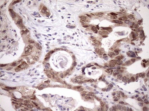 SCMH1 Antibody - Immunohistochemical staining of paraffin-embedded Adenocarcinoma of Human colon tissue using anti-SCMH1 mouse monoclonal antibody. (Heat-induced epitope retrieval by Tris-EDTA, pH8.0)(1:150)
