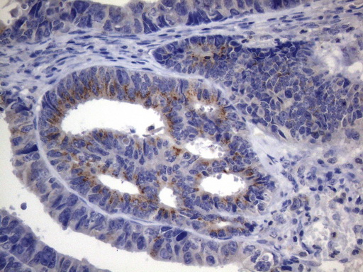 SCMH1 Antibody - Immunohistochemical staining of paraffin-embedded Adenocarcinoma of Human colon tissue using anti-SCMH1 mouse monoclonal antibody. (Heat-induced epitope retrieval by 1mM EDTA in 10mM Tris buffer. (pH8.5) at 120°C for 3 min. (1:150)