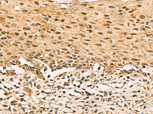 SCMH1 Antibody - Immunohistochemistry of paraffin-embedded Human cervical cancer tissue  using SCMH1 Polyclonal Antibody at dilution of 1:120(×200)
