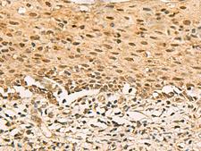 SCMH1 Antibody - Immunohistochemistry of paraffin-embedded Human cervical cancer tissue  using SCMH1 Polyclonal Antibody at dilution of 1:120(×200)
