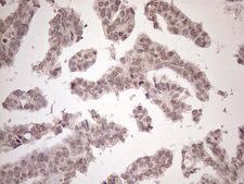 SCML2 Antibody - Immunohistochemical staining of paraffin-embedded Adenocarcinoma of Human ovary tissue using anti-SCML2 mouse monoclonal antibody. (Heat-induced epitope retrieval by 1mM EDTA in 10mM Tris buffer. (pH8.5) at 120°C for 3 min. (1:150)