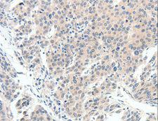 SCN10A / Nav1.8 Antibody - Immunohistochemistry of paraffin-embedded Human cervical cancer using SCN10A Polyclonal Antibody at dilution of 1:20.