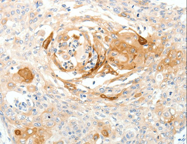 SCN10A / Nav1.8 Antibody - Immunohistochemistry of paraffin-embedded Human cervical cancer using SCN10A Polyclonal Antibody at dilution of 1:20.