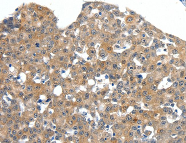 SCN11A / Nav1.9 Antibody - Immunohistochemistry of paraffin-embedded Human breast cancer using SCN11A Polyclonal Antibody at dilution of 1:40.