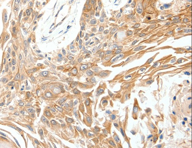 SCN11A / Nav1.9 Antibody - Immunohistochemistry of paraffin-embedded Human breast cancer using SCN11A Polyclonal Antibody at dilution of 1:40.