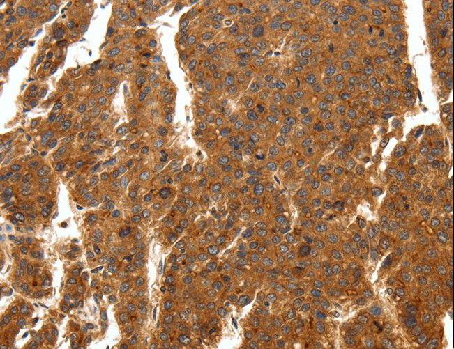 SCN11A / Nav1.9 Antibody - Immunohistochemistry of paraffin-embedded Human ovarian cancer using SCN11A Polyclonal Antibody at dilution of 1:50.