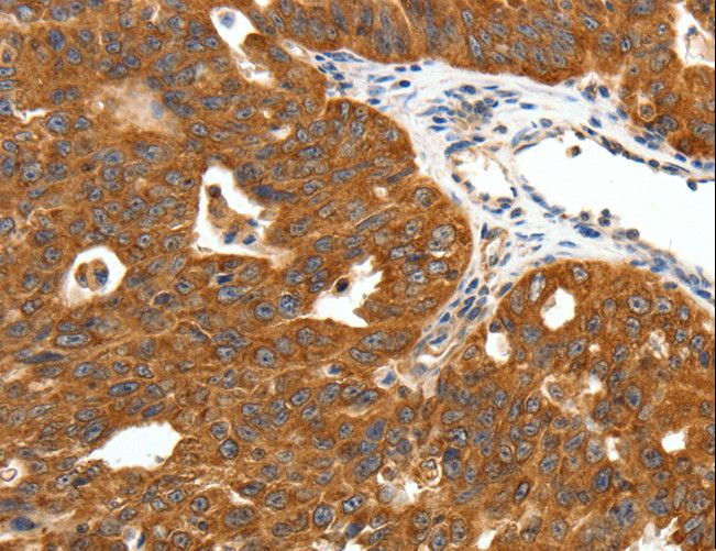 SCN11A / Nav1.9 Antibody - Immunohistochemistry of paraffin-embedded Human ovarian cancer using SCN11A Polyclonal Antibody at dilution of 1:50.