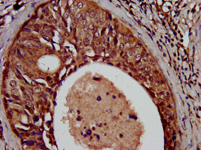 SCN11A / Nav1.9 Antibody - Immunohistochemistry image at a dilution of 1:500 and staining in paraffin-embedded human cervical cancer performed on a Leica BondTM system. After dewaxing and hydration, antigen retrieval was mediated by high pressure in a citrate buffer (pH 6.0) . Section was blocked with 10% normal goat serum 30min at RT. Then primary antibody (1% BSA) was incubated at 4 °C overnight. The primary is detected by a biotinylated secondary antibody and visualized using an HRP conjugated SP system.