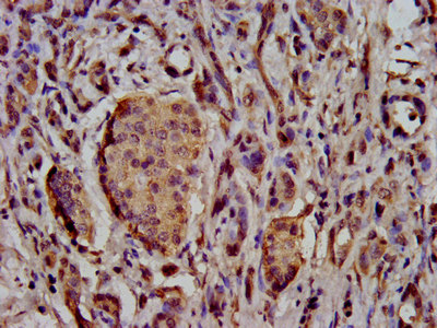 SCN11A / Nav1.9 Antibody - Immunohistochemistry image at a dilution of 1:500 and staining in paraffin-embedded human pancreatic cancer performed on a Leica BondTM system. After dewaxing and hydration, antigen retrieval was mediated by high pressure in a citrate buffer (pH 6.0) . Section was blocked with 10% normal goat serum 30min at RT. Then primary antibody (1% BSA) was incubated at 4 °C overnight. The primary is detected by a biotinylated secondary antibody and visualized using an HRP conjugated SP system.