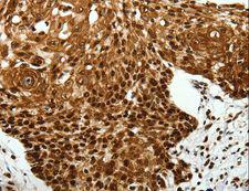 SCN1A / Nav1.1 Antibody - Immunohistochemistry of paraffin-embedded Human lung cancer using SCN1A/2A/3A/4A/5A/8A/9A/10A/11A/12A Polyclonal Antibody at dilution of 1:40.