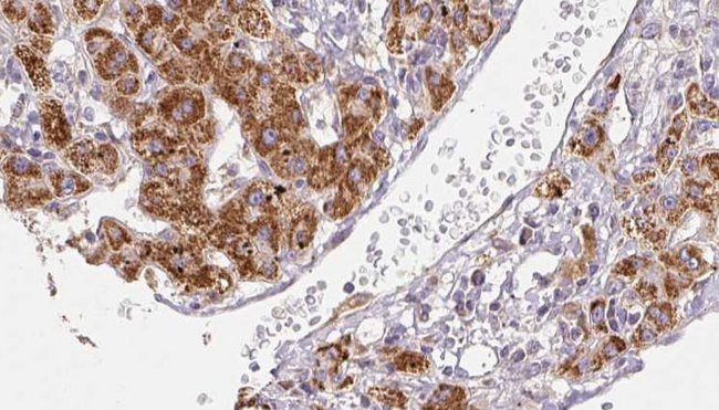 SCN2A / Nav1.2 Antibody - 1:100 staining human liver carcinoma tissues by IHC-P. The sample was formaldehyde fixed and a heat mediated antigen retrieval step in citrate buffer was performed. The sample was then blocked and incubated with the antibody for 1.5 hours at 22°C. An HRP conjugated goat anti-rabbit antibody was used as the secondary.