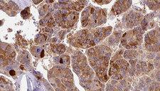 SCN3A / Nav1.3 Antibody - 1:100 staining human liver carcinoma tissues by IHC-P. The sample was formaldehyde fixed and a heat mediated antigen retrieval step in citrate buffer was performed. The sample was then blocked and incubated with the antibody for 1.5 hours at 22°C. An HRP conjugated goat anti-rabbit antibody was used as the secondary.