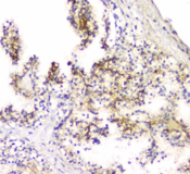 SCN4B Antibody - IHC staining of FFPE human renal cancer with SCN4B antibody at 1ug/ml. HIER: boil tissue sections in pH6, 10mM citrate buffer, for 10-20 min and allow to cool before testing.