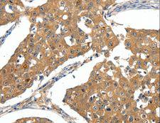 SCN5A / Nav1.5 Antibody - Immunohistochemistry of paraffin-embedded Human ovarian cancer using SCN5A Polyclonal Antibody at dilution of 1:30.