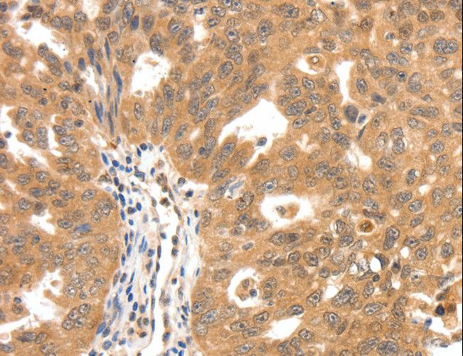 SCN5A / Nav1.5 Antibody - Immunohistochemistry of paraffin-embedded Human ovarian cancer using SCN5A Polyclonal Antibody at dilution of 1:30.