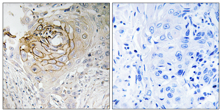 SCN9A / Nav1.7 Antibody - Immunohistochemistry analysis of paraffin-embedded human lung carcinoma tissue, using SCN9A Antibody. The picture on the right is blocked with the synthesized peptide.