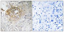 SCN9A / Nav1.7 Antibody - Immunohistochemistry analysis of paraffin-embedded human lung carcinoma tissue, using SCN9A Antibody. The picture on the right is blocked with the synthesized peptide.