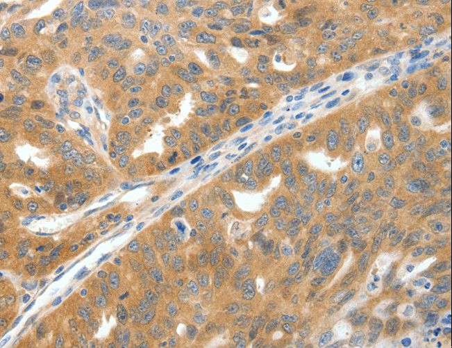 SCN9A / Nav1.7 Antibody - Immunohistochemistry of paraffin-embedded Human gastric cancer using SCN9A Polyclonal Antibody at dilution of 1:40.