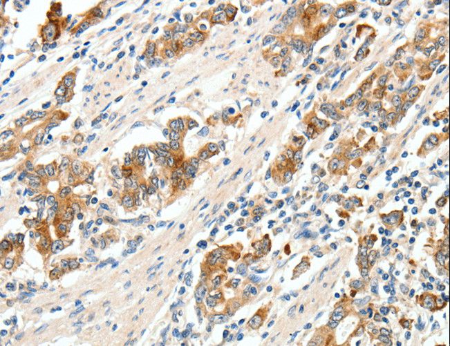 SCN9A / Nav1.7 Antibody - Immunohistochemistry of paraffin-embedded Human gastric cancer using SCN9A Polyclonal Antibody at dilution of 1:40.