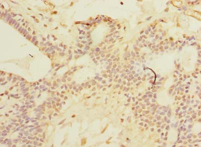 SCNM1 Antibody - Immunohistochemistry of paraffin-embedded human breast cancer using antibody at dilution of 1:100.