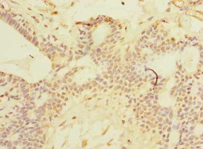 SCNM1 Antibody - Immunohistochemistry of paraffin-embedded human breast cancer using SCNM1 Antibody at dilution of 1:100