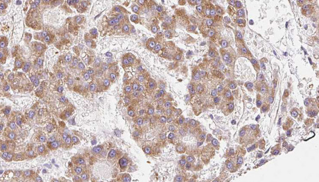 SCNN1A / ENaC Alpha Antibody - 1:100 staining human liver carcinoma tissues by IHC-P. The sample was formaldehyde fixed and a heat mediated antigen retrieval step in citrate buffer was performed. The sample was then blocked and incubated with the antibody for 1.5 hours at 22°C. An HRP conjugated goat anti-rabbit antibody was used as the secondary.