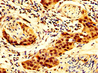 SCNN1B / ENaC Beta Antibody - Immunohistochemistry image at a dilution of 1:300 and staining in paraffin-embedded human bladder cancer performed on a Leica BondTM system. After dewaxing and hydration, antigen retrieval was mediated by high pressure in a citrate buffer (pH 6.0) . Section was blocked with 10% normal goat serum 30min at RT. Then primary antibody (1% BSA) was incubated at 4 °C overnight. The primary is detected by a biotinylated secondary antibody and visualized using an HRP conjugated SP system.