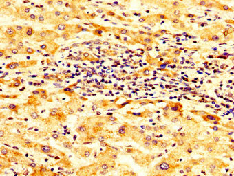 SCNN1B / ENaC Beta Antibody - Immunohistochemistry image at a dilution of 1:300 and staining in paraffin-embedded human liver cancer performed on a Leica BondTM system. After dewaxing and hydration, antigen retrieval was mediated by high pressure in a citrate buffer (pH 6.0) . Section was blocked with 10% normal goat serum 30min at RT. Then primary antibody (1% BSA) was incubated at 4 °C overnight. The primary is detected by a biotinylated secondary antibody and visualized using an HRP conjugated SP system.