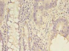 SCNN1G / ENaC Gamma Antibody - Immunohistochemistry of paraffin-embedded human colon cancer using antibody at 1:100 dilution.