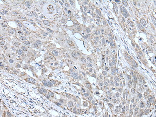 SCNN1G / ENaC Gamma Antibody - Immunohistochemistry of paraffin-embedded Human esophagus cancer tissue  using SCNN1G Polyclonal Antibody at dilution of 1:40(×200)