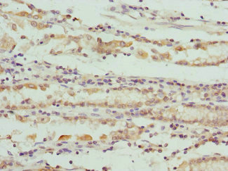 SCO2 Antibody - Immunohistochemistry of paraffin-embedded human gastric cancer at dilution 1:100
