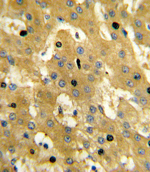 SCP2 / SCPX Antibody - Formalin-fixed and paraffin-embedded human hepatocarcinoma reacted with SCP2 Antibody , which was peroxidase-conjugated to the secondary antibody, followed by DAB staining. This data demonstrates the use of this antibody for immunohistochemistry; clinical relevance has not been evaluated.
