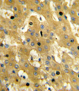 SCP2 / SCPX Antibody - Formalin-fixed and paraffin-embedded human hepatocarcinoma reacted with SCP2 Antibody , which was peroxidase-conjugated to the secondary antibody, followed by DAB staining. This data demonstrates the use of this antibody for immunohistochemistry; clinical relevance has not been evaluated.