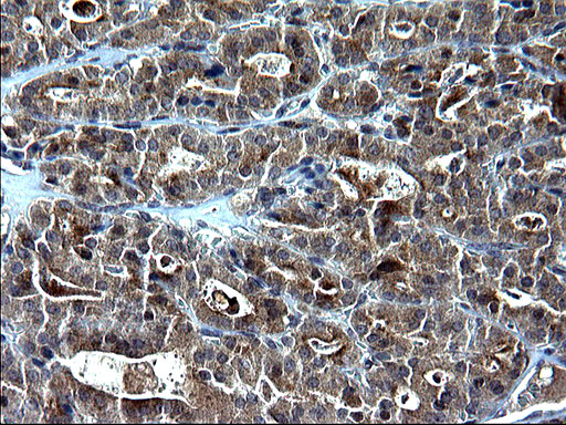 SCP2 / SCPX Antibody - IHC of paraffin-embedded Carcinoma of Human thyroid tissue using anti-SCP2 mouse monoclonal antibody. (Heat-induced epitope retrieval by 1 mM EDTA in 10mM Tris, pH8.5, 120°C for 3min).