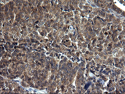 SCP2 / SCPX Antibody - IHC of paraffin-embedded Adenocarcinoma of Human endometrium tissue using anti-SCP2 mouse monoclonal antibody. (Heat-induced epitope retrieval by 1 mM EDTA in 10mM Tris, pH8.5, 120°C for 3min).