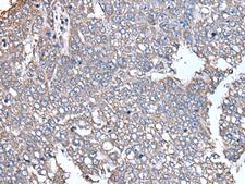 SCP2 / SCPX Antibody - Immunohistochemistry of paraffin-embedded Human liver cancer tissue  using SCP2 Polyclonal Antibody at dilution of 1:35(×200)