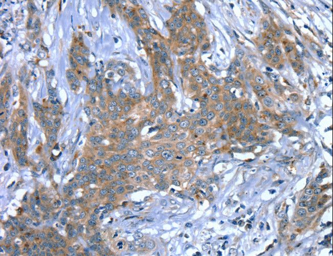 SCPEP1 / RISC Antibody - Immunohistochemistry of paraffin-embedded Human cervical cancer using SCPEP1 Polyclonal Antibody at dilution of 1:30.